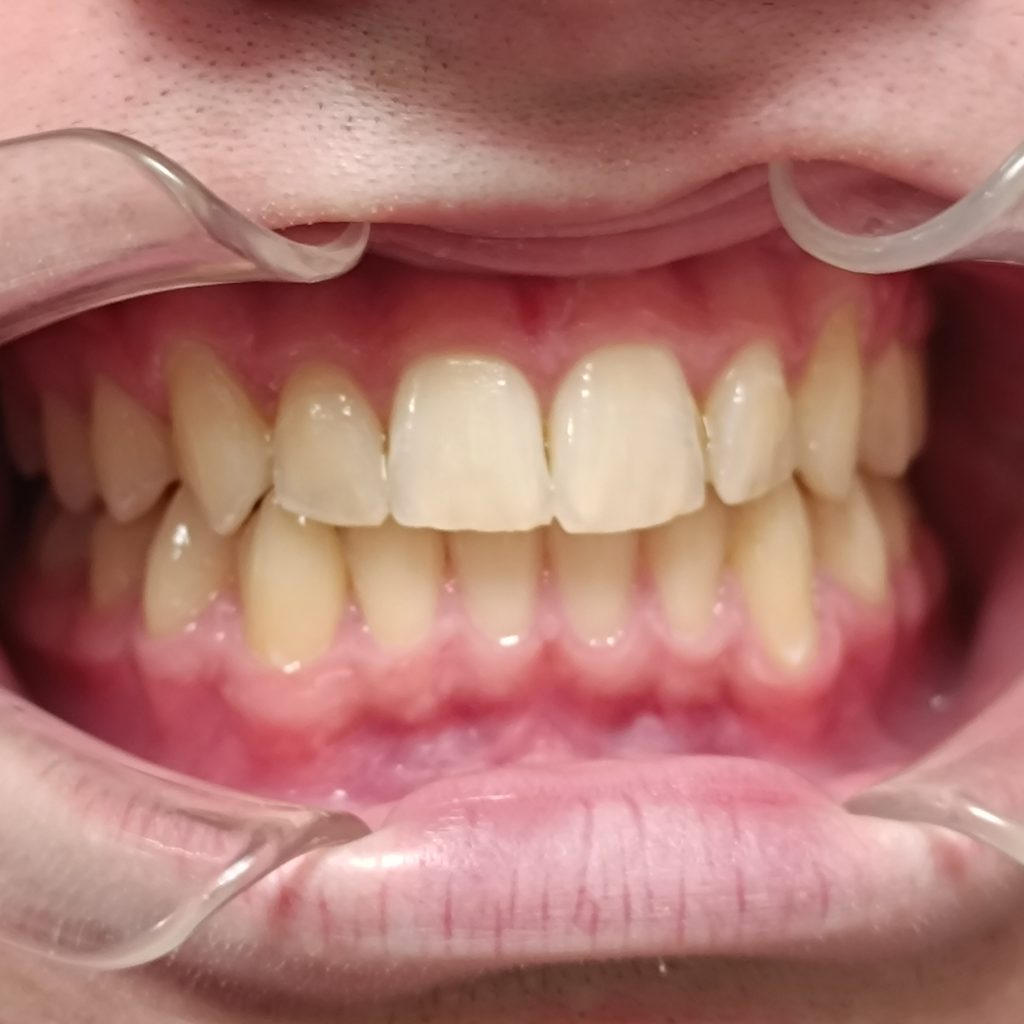 Случай 11, после лечения: элайнеры Invisalign