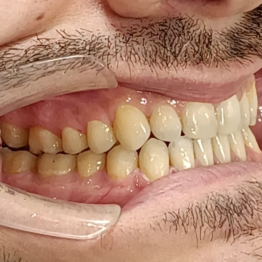 Случай 7, после лечения: элайнеры Invisalign с минивинтами