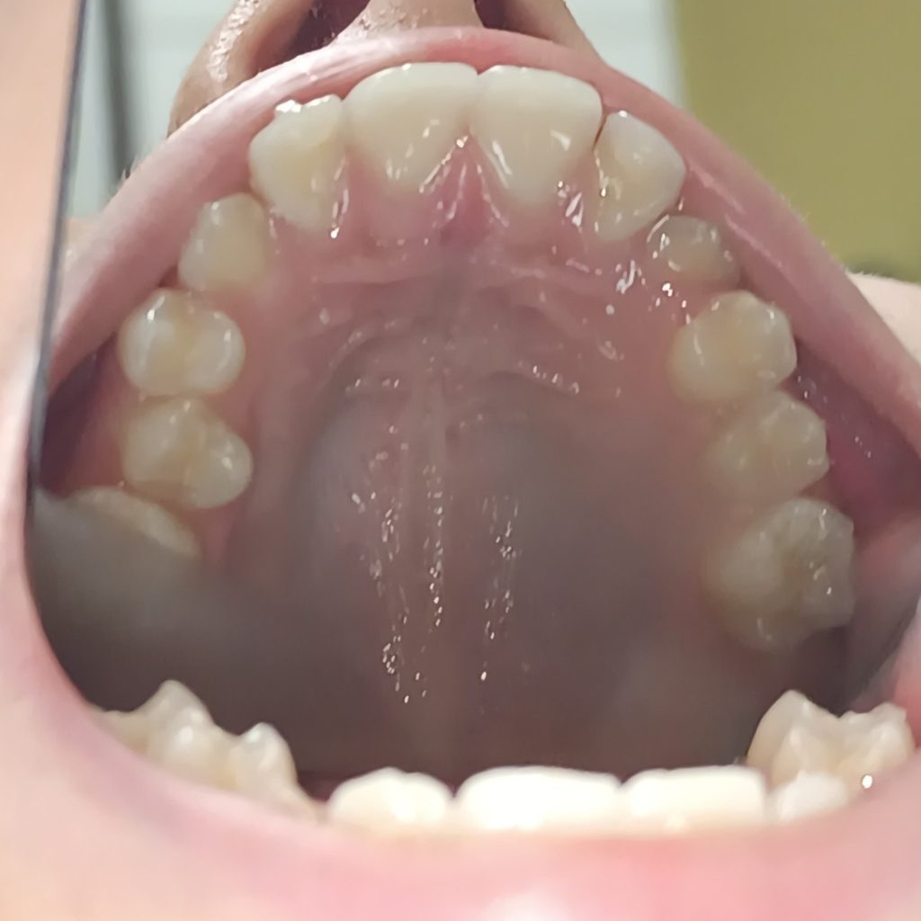 Случай 12, после лечения: элайнеры Invisalign First